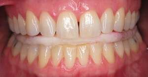 Custom TMJ Mouthguard