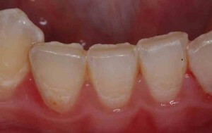 Several Teeth Showing Acid Erosion