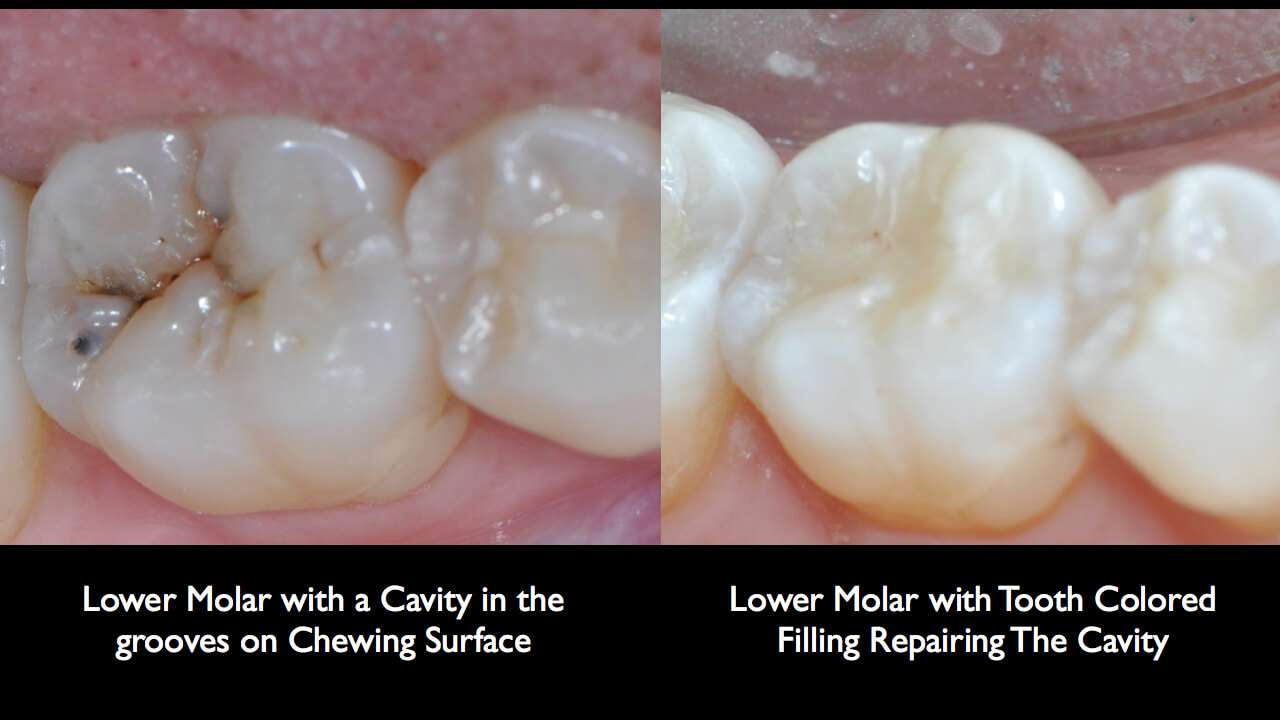 What Are Tooth Coloured Fillings?